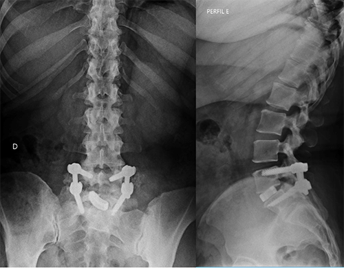 Implantes de Artrodese Lombar
