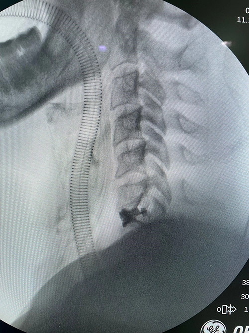Detalhe do Implante Cervical