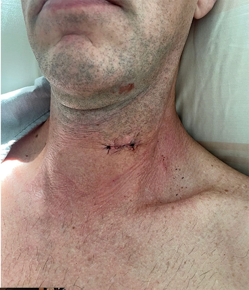 Artrodese Cervical - Abordagem Anterior